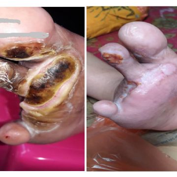 testmony double stem cell Cancer